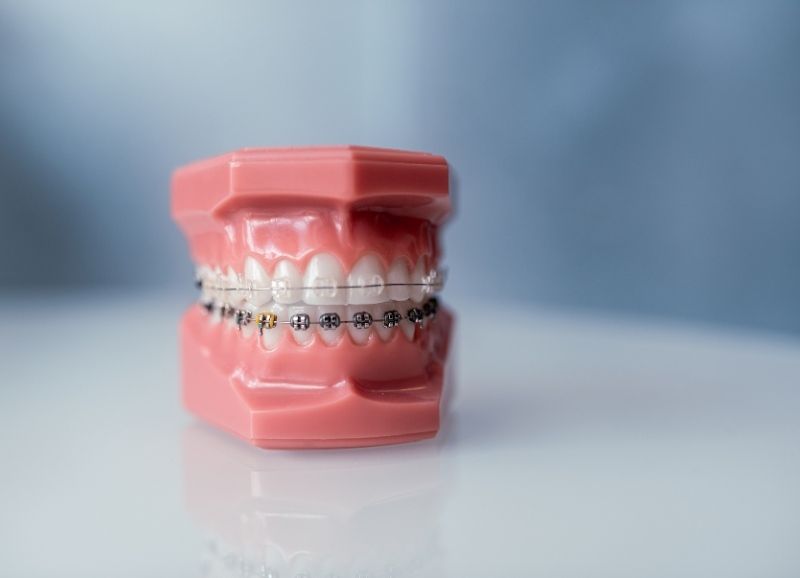 Niềng Răng Hô Bao Nhiêu Tiền